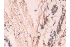 IHC-P analysis of Human Breast cancer Tissue, with DAB staining. (Caspase 7 Antikörper  (AA 24-198))