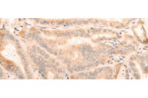 Immunohistochemistry of paraffin-embedded Human thyroid cancer tissue using ELP4 Polyclonal Antibody at dilution of 1:25(x200)