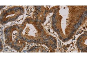 Immunohistochemistry of paraffin-embedded Human colon cancer using CK-16 Polyclonal Antibody at dilution of 1:30