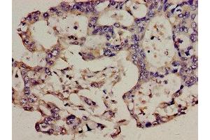 Immunohistochemistry analysis of human pancreatic cancer using ABIN7171289 at dilution of 1:100 (TCRb Antikörper  (AA 22-115))