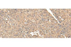 Immunohistochemistry of paraffin-embedded Human liver cancer tissue using BDH2 Polyclonal Antibody at dilution of 1:65(x200)
