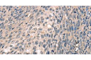Immunohistochemistry of paraffin-embedded Human cervical cancer tissue using CDK12 Polyclonal Antibody at dilution 1:30 (CDK12 Antikörper)