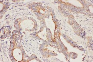 Anti- Fatty Acid Binding Protein 5 antibody, IHC(P) IHC(P): Human Intestinal Cancer Tissue