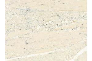 ABIN6264651 and ABIN6273154 at 1/100 staining human tongue carcinoma by IHC-P.