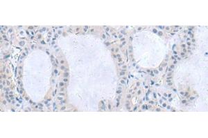 Immunohistochemistry of paraffin-embedded Human thyroid cancer tissue using IL1B Polyclonal Antibody at dilution of 1:55(x200) (IL-1 beta Antikörper)