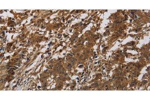 Immunohistochemistry of paraffin-embedded Human liver cancer tissue using ITGB7 Polyclonal Antibody at dilution of 1:40 (Integrin beta 7 Antikörper)