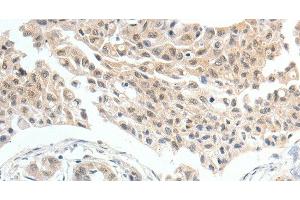 Immunohistochemistry of paraffin-embedded Human lung cancer tissue using MDK Polyclonal Antibody at dilution 1:60 (Midkine Antikörper)