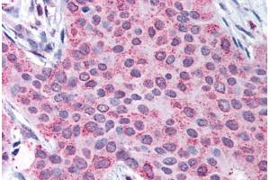 Human Breast Carcinoma (formalin-fixed, paraffin-embedded) stained with MMP13 antibody ABIN290538 at 50 ug/ml followed by biotinylated goat anti-rabbit IgG secondary antibody ABIN481713, alkaline phosphatase-streptavidin and chromogen. (MMP13 Antikörper  (C-Term))