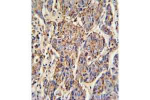 Formalin-fixed and paraffin-embedded human hepatocarcinoma with CATB Antibody (Center), which was peroxidase-conjugated to the secondary antibody, followed by DAB staining. (Tyrosinase-Related Protein 1 Antikörper  (AA 198-227))