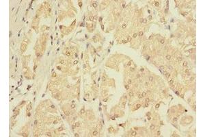 Immunohistochemistry of paraffin-embedded human gastric cancer using ABIN7176445 at dilution of 1:100 (ZNF624 Antikörper  (AA 127-327))