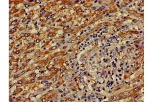 Immunohistochemistry of paraffin-embedded human liver cancer using ABIN7148816 at dilution of 1:100 (CREB3L1 Antikörper  (AA 396-500))