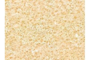 ABIN6266047 and ABIN6278956 at 1/100 staining human astrocytoma by IHC-P.