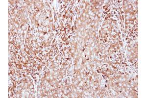 IHC-P Image Immunohistochemical analysis of paraffin-embedded A549 xenograft, using MMP3, antibody at 1:500 dilution. (MMP3 Antikörper)