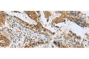 Immunohistochemistry of paraffin-embedded Human cervical cancer tissue using TUBD1 Polyclonal Antibody at dilution of 1:70(x200) (TUBD1 Antikörper)