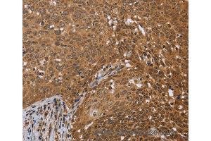 Immunohistochemistry of Human cervical cancer using FKBP8 Polyclonal Antibody at dilution of 1:50