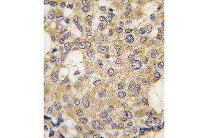 Formalin-fixed and paraffin-embedded human breast carcinoma tissue reacted with Parg antibody (C-term) (ABIN391439 and ABIN2841426) , which was peroxidase-conjugated to the secondary antibody, followed by DAB staining.