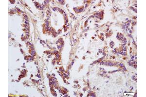 Formalin-fixed and paraffin embedded human gastric carcinoma labeled with Anti GNA12/G protein alpha 12 Polyclonal Antibody, Unconjugated (ABIN753958) at 1:200 followed by conjugation to the secondary antibody and DAB staining (GNA12 Antikörper  (AA 301-381))