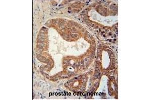 CSGALNACT1 Antibody (Center) (ABIN651115 and ABIN2840081) immunohistochemistry analysis in formalin fixed and paraffin embedded human prostate carcinoma followed by peroxidase conjugation of the secondary antibody and DAB staining. (CSGALNACT1 Antikörper  (AA 192-220))