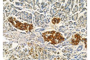 ABIN7093901 and ABIN7097945 at 1/100 staining Human gastric cancer and adjacent non-tumor tissue by IHC-P.