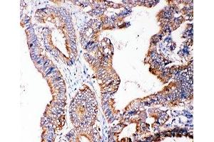 IHC-P: SMAD5 antibody testing of human intestine cancer tissue (SMAD5 Antikörper  (Middle Region))