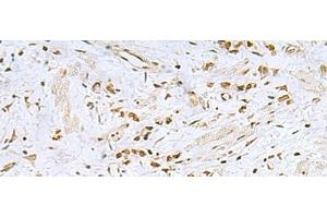 Immunohistochemistry of paraffin-embedded Human gastric cancer tissue using FOXQ1 Polyclonal Antibody at dilution of 1:25(x200) (FOXQ1 Antikörper)