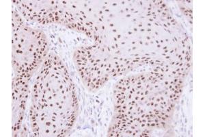 IHC-P Image Immunohistochemical analysis of paraffin-embedded Cal27 xenograft, using RPA 70 kDa subunit , antibody at 1:100 dilution. (RPA1 Antikörper  (C-Term))