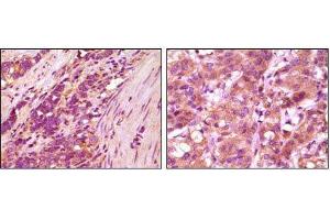 Immunohistochemical analysis of paraffin-embedded human stomach carcinoma (left) and breast carcinoma (right), showing cytoplasmic localization using fibulin5 mouse mAb with DAB staining.