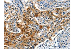 The image on the left is immunohistochemistry of paraffin-embedded Human lung cancer tissue using ABIN7190321(COG1 Antibody) at dilution 1/60, on the right is treated with synthetic peptide.