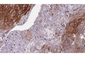 ABIN6276819 at 1/100 staining Human urothelial cancer tissue by IHC-P. (S100A8 Antikörper  (C-Term))