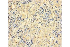 Immunohistochemistry of paraffin-embedded human lung cancer using ABIN7156529 at dilution of 1:100 (CCDC36 Antikörper  (AA 11-592))