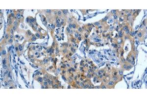 Immunohistochemistry of paraffin-embedded Human lung cancer tissue using MUC15 Polyclonal Antibody at dilution 1:50 (MUC15 Antikörper)