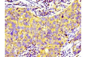 Immunohistochemistry of paraffin-embedded human pancreatic cancer using ABIN7158932 at dilution of 1:100 (PRNP Antikörper  (AA 23-64))