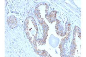 Formalin-fixed, paraffin-embedded human Prostate Carcinoma stained with PMEPA1 Mouse Monoclonal Antibody (PMEPA1/2697). (PMEPA1 Antikörper)