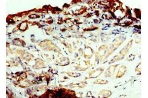 Immunohistochemistry of paraffin-embedded human breast cancer using ABIN7143737 at dilution of 1:100 (FUT6 Antikörper  (AA 170-359))