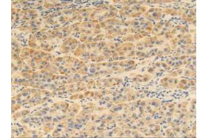 IHC-P analysis of Human Liver Cancer Tissue, with DAB staining. (MGP Antikörper  (AA 1-103))