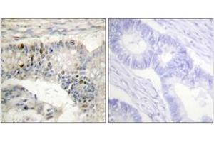 Immunohistochemistry analysis of paraffin-embedded human colon carcinoma tissue, using Histone H1 (Ab-17) Antibody. (Histone H1 Antikörper  (AA 1-50))