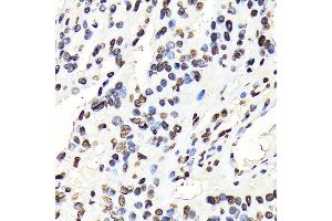 Immunohistochemistry of paraffin-embedded human oophoroma using Phospho-STA-Y694 antibody (ABIN6135328, ABIN6136272, ABIN6136273 and ABIN7101887) at dilution of 1:100 (40x lens). (STAT5A Antikörper  (pTyr694))