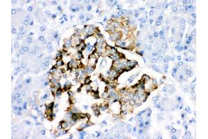 Anti- BAG2 Picoband antibody,IHC(P) IHC(P): Human Pancreatic Cancer Tissue (BAG2 Antikörper  (AA 1-211))