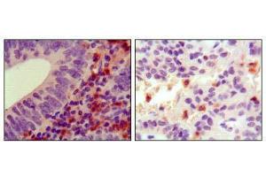 Immunohistochemical analysis of paraffin-embedded human colon cancer (left) and ancreas cancer (right), showing cytoplasmic localization using HCK mouse mAb with DAB staining.