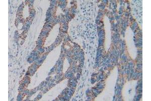 IHC-P analysis of Human Rectum Cancer Tissue, with DAB staining. (C1QBP Antikörper  (AA 76-282))