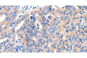 Immunohistochemistry of paraffin-embedded Human ovarian cancer tissue using KLK2 Polyclonal Antibody at dilution 1:100 (Kallikrein 2 Antikörper)