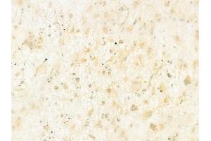 ABIN6260790 and ABIN6273098 at 1/100 staining human astrocytoma by IHC-P.
