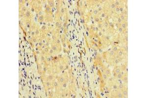 Immunohistochemistry of paraffin-embedded human liver cancer using ABIN7172463 at dilution of 1:100 (TCF4 Antikörper  (AA 419-525))