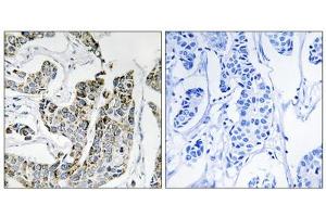Immunohistochemistry analysis of paraffin-embedded human breast carcinoma tissue using BLK (Phospho-Tyr501) antibody. (BLK Antikörper  (pTyr501))
