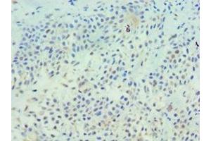 Immunohistochemistry of paraffin-embedded human breast cancer using ABIN7173326 at dilution of 1:100 (TFF1 Antikörper  (AA 25-84))