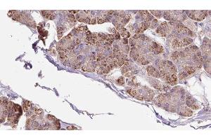 ABIN6273285 at 1/100 staining Human pancreas cancer tissue by IHC-P. (PACS2 Antikörper  (Internal Region))
