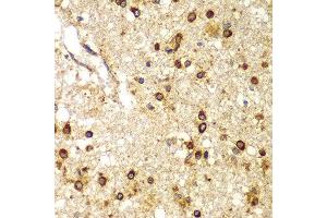 Immunohistochemistry of paraffin-embedded human brain cancer using SMAD9 antibody at dilution of 1:100 (x400 lens). (SMAD9 Antikörper)