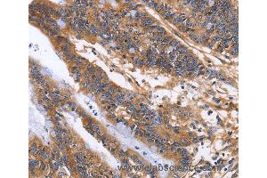 Immunohistochemistry of Human colon cancer using ITGB1 Polyclonal Antibody at dilution of 1:60 (ITGB1 Antikörper)