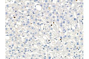 ABIN6263158 and ABIN6266586 at 1/100 staining Human liver cancer and adjacent normal tissues by IHC-P. (MCM2 Antikörper  (N-Term))