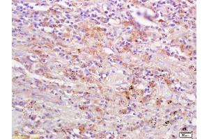 Formalin-fixed and paraffin embedded human lung carcinoma labeled Anti-DAPK2/DRP1 Polyclonal Antibody, Unconjugated (ABIN733358) at 1:200, followed by conjugation to the secondary antibody and DAB staining (Dapk1/2 (AA 271-370) Antikörper)